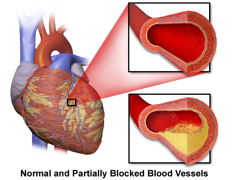 cardiovascular disease atherosclerotic cardiovascular disease hypertensive cardiovascular disease hypertensive cardiovascular disease icd 10 arteriosclerosis cardiovascular disease hypertensive atherosclerotic cardiovascular disease what causes cardiovascular disease signs of cardiovascular disease qrisk2 cardiovascular disease journal of cardiovascular disease research how to prevent cardiovascular disease cardiovascular disease and coronary heart disease are often used interchangeably cardiovascular disease and cancer shared risk factors and mechanisms cardiovascular disease abbreviation cardiovascular disease and heart disease are same cardiovascular disease and stroke risk screening cardiovascular disease and diabetes cardiovascular disease articles cardiovascular disease aha functional classification cardiovascular disease acronym atherosclerotic and hypertensive cardiovascular disease atherosclerotic cardiovascular disease icd 10 atherosclerosis cardiovascular disease atherosclerotic cardiovascular disease ascvd arteriosclerosis cardiovascular disease death associates in cardiovascular disease arteriosclerotic and hypertensive cardiovascular disease acute cardiovascular disease cardiovascular disease blood test cardiovascular disease board certification verification cardiovascular disease be reversed cardiovascular disease burden cardiovascular disease by country cardiovascular disease biomarkers cardiovascular disease brochure cardiovascular disease book cardiovascular disease book pdf cardiovascular disease bangla blood test for cardiovascular disease breast arterial calcification and cardiovascular disease burden of cardiovascular disease best diet for cardiovascular disease benign hypertensive cardiovascular disease icd 10 biomarkers for cardiovascular disease bmc cardiovascular disease bac and cardiovascular disease burn pits and cardiovascular disease best glp 1 for cardiovascular disease cardiovascular disease causes cardiovascular disease class 3 or 4 cardiovascular disease calculator cardiovascular disease cure cardiovascular disease cdc cardiovascular disease can be cured cardiovascular disease can it be reversed cardiovascular disease cad cardiovascular disease cause of death cardiovascular disease conditions causes of cardiovascular disease coronary atherosclerosis due to arteriosclerotic cardiovascular disease can cardiovascular disease be reversed cardiovascular disease symptoms can cardiovascular disease be cured chronic cardiovascular disease cvd cardiovascular disease caffeine and cardiovascular disease cardiovascular disease definition cardiovascular disease doctor cardiovascular disease diet cardiovascular disease diagnosis cardiovascular disease death cardiovascular disease diagnosis code cardiovascular disease death rate cardiovascular disease doctors near me cardiovascular disease diabetes cardiovascular disease diet plan define cardiovascular disease diabetes and cardiovascular disease difference between hypertension and cardiovascular disease diet for cardiovascular disease drugs for cardiovascular disease different types of cardiovascular disease diagnosis of cardiovascular disease does smoking cause cardiovascular disease does hypertension count as cardiovascular disease does nicotine cause cardiovascular disease cardiovascular disease examples cardiovascular disease encompasses which of the following conditions cardiovascular disease epidemiology cardiovascular disease etiology cardiovascular disease exercise cardiovascular disease explained cardiovascular disease events cardiovascular disease ear lobe crease cardiovascular disease early symptoms cardiovascular disease en español examples of cardiovascular disease established cardiovascular disease early signs of cardiovascular disease epidemiology of cardiovascular disease evolocumab and clinical outcomes in patients with cardiovascular disease effects of cardiovascular disease explain cardiovascular disease estrogen and cardiovascular disease erectile dysfunction and cardiovascular disease european heart journal cardiovascular disease in women cardiovascular disease fellowship cardiovascular disease facts cardiovascular disease fellowship vs cardiology cardiovascular disease fellow cardiovascular disease from alcohol cardiovascular disease from smoking cardiovascular disease foods to eat cardiovascular disease fellowship programs cardiovascular disease family history cardiovascular disease fatigue family history of cardiovascular disease icd 10 fh cardiovascular disease family hx of cardiovascular disease icd 10 family history of cardiovascular disease facts about cardiovascular disease framingham study of cardiovascular disease flossing and cardiovascular disease frank's sign cardiovascular disease foods to avoid with cardiovascular disease forms of cardiovascular disease cardiovascular disease genetic cardiovascular disease guidelines cardiovascular disease graphic cardiovascular disease gwas cardiovascular disease global statistics cardiovascular disease genetic testing cardiovascular disease guidelines kenya cardiovascular disease gcse biology cardiovascular disease global burden cardiovascular disease gcse glp 1 for cardiovascular disease glp 1 for cardiovascular disease fda approved global burden of cardiovascular disease genetic cardiovascular disease glp 1 approved for cardiovascular disease gout and cardiovascular disease genetic testing for cardiovascular disease gender differences in cardiovascular disease guideline on the primary prevention of cardiovascular disease gut microbiota and cardiovascular disease cardiovascular disease how do you get it cardiovascular disease how to prevent cardiovascular disease how is it diagnosed cardiovascular disease hereditary cardiovascular disease hypertension cardiovascular disease heart attack cardiovascular disease hyperlipidemia cardiovascular disease htn cardiovascular disease heart disease hypertensive arteriosclerotic cardiovascular disease hypertensive atherosclerotic cardiovascular disease icd 10 hypertensive cardiovascular disease cause of death hypertensive atherosclerosis cardiovascular disease cause of death hypertensive arteriosclerotic cardiovascular disease icd 10 hypertensive cardiovascular disease meaning cardiovascular disease icd 10 cardiovascular disease is the leading cause of death cardiovascular disease in the united states cardiovascular disease in spanish cardiovascular disease in women cardiovascular disease icd 10 code cardiovascular disease is what cardiovascular disease in dogs cardiovascular disease in chinese is hypertension a cardiovascular disease is stroke a cardiovascular disease is high blood pressure a cardiovascular disease is atherosclerosis a cardiovascular disease is hyperlipidemia a cardiovascular disease is diabetes a cardiovascular disease is afib a cardiovascular disease icd 10 cardiovascular disease is hypertension considered cardiovascular disease is high cholesterol a cardiovascular disease cardiovascular disease journal articles cardiovascular disease journals cardiovascular disease journal articles pdf cardiovascular disease jobs cardiovascular disease journal impact factor cardiovascular disease japanese cardiovascular disease japan coronary artery disease journal coronary artery disease journal pdf heart disease japan vs america journal of cardiovascular disease research indexing jrsm cardiovascular disease journal of cardiovascular disease research impact factor jbs cardiovascular disease journal of cardiovascular disease journal of rare cardiovascular disease jrsm cardiovascular disease impact factor jardiance for cardiovascular disease journal of cardiovascular disease research publication fee cardiovascular disease knowledge portal cardiovascular disease kya hota hai cardiovascular disease ki cardiovascular disease kaggle cardiovascular disease kannada meaning cardiovascular disease kidney cardiovascular disease kids cardiovascular disease ketogenic diet cardiovascular disease kaggle dataset cardiovascular disease kannada kaggle cardiovascular disease dataset key symptoms of cardiovascular disease keto diet and cardiovascular disease kinds of cardiovascular disease kidney disease and cardiovascular disease kimberly dulaney md cardiovascular disease key facts about cardiovascular disease key risk factors for cardiovascular disease kaggle cardiovascular disease kidney stones and cardiovascular disease cardiovascular disease leading cause of death cardiovascular disease leading cause of death worldwide cardiovascular disease list cardiovascular disease life expectancy cardiovascular disease lab tests cardiovascular disease lupus cardiovascular disease là gì cardiovascular disease leading cause of death in women cardiovascular disease legs cardiovascular disease lifestyle risk factors low dose colchicine in cardiovascular disease list of cardiovascular disease leading cause of cardiovascular disease lipoprotein a and cardiovascular disease light exposure at night and cardiovascular disease incidence lupus and cardiovascular disease long term effects of cardiovascular disease lipid screening for cardiovascular disease link between kidney disease and cardiovascular disease lipoprotein a reduction in persons with cardiovascular disease cardiovascular disease meaning cardiovascular disease medications cardiovascular disease medicine cardiovascular disease medical term cardiovascular disease management cardiovascular disease meds cardiovascular disease men vs women cardiovascular disease mortality rate cardiovascular disease medical abbreviation cardiovascular disease mortality meaning of cardiovascular disease modifiable risk factors for cardiovascular disease micro cardiovascular disease medications for cardiovascular disease menopause and cardiovascular disease management of cardiovascular disease most common cardiovascular disease medicine for cardiovascular disease mounjaro and cardiovascular disease merck cardiovascular disease specialist cardiovascular disease non modifiable risk factors cardiovascular disease names cardiovascular disease number one killer cardiovascular disease news articles cardiovascular disease near me cardiovascular disease nih cardiovascular disease nails cardiovascular disease news cardiovascular disease nhs cardiovascular disease nz non modifiable risk factors for cardiovascular disease national institute of cardiovascular disease and hospital nhs cardiovascular disease nicotine and cardiovascular disease nursing care plan for cardiovascular disease ppt national institute of cardiovascular disease nursing management of cardiovascular disease pdf nice cardiovascular disease nursing diagnosis for cardiovascular disease nice guidelines cardiovascular disease cardiovascular disease overview cardiovascular disease older adults cardiovascular disease or disorder cardiovascular disease other names cardiovascular disease of the heart cardiovascular disease operation cardiovascular disease obesity cardiovascular disease oral health cardiovascular disease ozempic cardiovascular disease or stroke obesity and cardiovascular disease organic cardiovascular disease ozempic for cardiovascular disease oral health and cardiovascular disease osa and cardiovascular disease organic cardiovascular disease death osteoporosis and cardiovascular disease an update obstructive sleep apnea and cardiovascular disease overview of cardiovascular disease obesity and cardiovascular disease pdf cardiovascular disease prevention cardiovascular disease physician cardiovascular disease prevalence in the us cardiovascular disease prevalence cardiovascular disease ppt cardiovascular disease pathophysiology cardiovascular disease pronunciation cardiovascular disease prevention guidelines cardiovascular disease peer reviewed articles cardiovascular disease postpartum primary prevention of cardiovascular disease prevention of cardiovascular disease premature cardiovascular disease pathophysiology of cardiovascular disease prevalence of cardiovascular disease psoriasis and cardiovascular disease prevention and control of cardiovascular disease predicting risk of cardiovascular disease events primary vs secondary prevention of cardiovascular disease peripheral cardiovascular disease cardiovascular disease quizlet cardiovascular disease quiz cardiovascular disease qrisk2 cardiovascular disease questions and answers cardiovascular disease questionnaire pdf cardiovascular disease que es cardiovascular disease questions cardiovascular disease quizlet nclex cardiovascular disease questionnaire cardiovascular disease quiz quizlet qrisk2 cardiovascular disease 10 year risk score qrisk2 cardiovascular disease 10 year risk qrisk3 cardiovascular disease qrisk2 cardiovascular disease score qrisk3 cardiovascular disease 10 year risk qrisk cardiovascular disease qrisk cardiovascular disease 10 year risk qrisk3 cardiovascular disease score qrisk2 cardiovascular disease 10 year cardiovascular disease risk factors cardiovascular disease risk calculator cardiovascular disease risk cardiovascular disease risk factors modifiable and nonmodifiable cardiovascular disease risk assessment cardiovascular disease reversal cardiovascular disease risk score cardiovascular disease risk in women with menopause cardiovascular disease rates by country cardiovascular disease research risk factors for cardiovascular disease risk of cardiovascular disease reverse cardiovascular disease rheumatoid arthritis and cardiovascular disease relationship between hypertension and cardiovascular disease risk of cardiovascular disease calculator red meat cardiovascular disease role of nutraceuticals in cardiovascular disease reduction in saturated fat intake for cardiovascular disease risk score cardiovascular disease cardiovascular disease specialist merck cardiovascular disease screening cardiovascular disease specialist cardiovascular disease symptoms in women cardiovascular disease specialist merck salary cardiovascular disease specialists of pittsburgh pc cardiovascular disease statistics cardiovascular disease screening test symptoms of cardiovascular disease is cardiovascular disease the same as heart disease screening for cardiovascular disease icd 10 secondary prevention of cardiovascular disease signs and symptoms of cardiovascular disease smoking and cardiovascular disease stress and cardiovascular disease symptoms of cardiovascular disease in women cardiovascular disease treatment cardiovascular disease testing cardiovascular disease the same as heart disease cardiovascular disease types cardiovascular disease taxonomy code cardiovascular disease treatment and prevention cardiovascular disease treatment medication cardiovascular disease trends cardiovascular disease treatable cardiovascular disease type 1 diabetes types of cardiovascular disease treatment for cardiovascular disease triglyceride hdl ratio prediction for cardiovascular disease test for cardiovascular disease therapeutic advances in cardiovascular disease type 2 diabetes and cardiovascular disease the most common cardiovascular disease the meaning of cardiovascular disease the cardiovascular disease the causes of cardiovascular disease cardiovascular disease unspecified icd 10 cardiovascular disease uk cardiovascular disease unspecified cardiovascular disease uk statistics cardiovascular disease us cardiovascular disease umbrella term cardiovascular disease united states cardiovascular disease us statistics cardiovascular disease unspecified icd 10 code underlying cardiovascular disease uric acid and cardiovascular disease uab cardiovascular disease understanding cardiovascular disease unified theory of human cardiovascular disease uncontrollable risk factors for cardiovascular disease urine test for cardiovascular disease us cardiovascular disease statistics uk cardiovascular disease factsheet unhealthy diet and cardiovascular disease cardiovascular disease vs coronary artery disease cardiovascular disease vs coronary heart disease cardiovascular disease vs heart disease cardiovascular disease vs cardiology cardiovascular disease vs interventional cardiology cardiovascular disease vs cad cardiovascular disease vs hypertension cardiovascular disease vs heart failure cardiovascular disease vs peripheral vascular disease cardiovascular disease vs congestive heart failure vaping and cardiovascular disease vitamin d and cardiovascular disease varicose veins cardiovascular disease valvular cardiovascular disease vitamin d and cardiovascular disease an update vitamin d deficiency and cardiovascular disease va rating for cardiovascular disease vitamin e and cardiovascular disease vitamin k2 and cardiovascular disease viagra for cardiovascular disease cardiovascular disease what is it cardiovascular disease wiki cardiovascular disease what causes it cardiovascular disease wegovy cardiovascular disease what to eat cardiovascular disease what does it mean cardiovascular disease warning signs cardiovascular disease worldwide cardiovascular disease world health organization cardiovascular disease worldwide statistics what is cardiovascular disease what is atherosclerotic cardiovascular disease what is hypertensive cardiovascular disease what is the meaning of cardiovascular disease what are the symptoms of cardiovascular disease what is qrisk2 cardiovascular disease what is arteriosclerosis cardiovascular disease what is hypertensive and atherosclerotic cardiovascular disease what is secondary prevention of cardiovascular disease cardiovascular disease x ray cardiac disease x ray cardiac disease x heart disease x ray coronary artery disease x ray heart disease x ray images heart disease x ray findings heart disease x fh cardiovascular disease (xe0of) cardiovascular disease chest x ray xylitol cardiovascular disease xanthomas cardiovascular disease chest x ray cardiovascular disease does xylitol increase risk of cardiovascular disease is cardiovascular disease heart disease what are 5 cardiovascular diseases what are the 4 types of cardiovascular disease cardiovascular disease youtube cardiovascular disease young adults cardiovascular disease yoga coronary artery disease youtube heart disease young women heart disease young people heart disease yoga coronary artery disease young age heart disease you can die from heart disease young adults yoga for cardiovascular disease yoga therapy for cardiovascular disease yoga asanas for cardiovascular disease yogurt and cardiovascular disease youtube cardiovascular disease yoga for cardiovascular disease and rehabilitation your patient has a history of cardiovascular disease young cardiovascular disease your qrisk2 cardiovascular disease yale cardiovascular disease cardiovascular disease zero to finals cardiovascular disease zepbound cardiovascular disease zyn cardiovascular disease zhongwen coronary artery disease zero to finals cardiovascular condition z13 6 heart disease zone tool cardiovascular disorders z13 6 heart disease zepbound coronary artery disease zhongwen zepbound for cardiovascular disease zero to finals cardiovascular disease zyn cardiovascular disease zoloft and cardiovascular disease zinc and cardiovascular disease zebrafish as a tractable model of human cardiovascular disease zepbound approved for cardiovascular disease zebrafish models of cardiovascular disease cardiovascular disease in new zealand cardiovascular disease in aotearoa new zealand cardiovascular disease 0.6 cardiovascular disease 0.2 cardiovascular disease 0.8 cardiovascular risk 0.7 cardiovascular disease symptoms in men cardiovascular disease symptoms in tamil cardiovascular disease symptoms in legs cardiovascular disease symptoms in hindi is cad cardiovascular disease 8 cardiovascular diseases 6 cardiovascular diseases cardiovascular disease 10 year risk score cardiovascular disease 10 year risk calculator score cardiovascular disease 10 year risk score qrisk2 cardiovascular disease 10 year risk score nhs cardiovascular disease 10 year risk score 0.5 cardiovascular disease 10 year risk cardiovascular disease 10 year risk score 0.6 cardiovascular disease 10 year risk score uk cardiovascular disease 10 year risk score 1.8 cardiovascular disease 10 year risk score 1.1 10 year risk of cardiovascular disease 10 year risk of cardiovascular disease calculator 10 year risk score for cardiovascular disease 10 risk factors for cardiovascular disease 10 year risk of cardiovascular disease uk 10 year cardiovascular disease cvd risk 1 strategy to prevent cardiovascular disease #1 cause of cardiovascular disease 10 risk factors for cardiovascular disease calculator 10 cardiovascular disease cardiovascular disease 2.1 cardiovascular disease 2025 cardiovascular disease 2026 • 2. cardiovascular disease cardiovascular disease 2023 heart disease 2025 coronary artery disease 2d echo coronary artery disease 25 year old cardiovascular risk 2 coronary artery disease 2 2021 esc guidelines on cardiovascular disease prevention 2 risk factors for cardiovascular disease 2 types of cardiovascular disease 2 cardiovascular diseases 2 cardiovascular 2 diseases of cardiovascular system cardiovascular disease 3d model cardiovascular disease 3.3 cardiovascular disease 3.2 coronary artery disease 3 vessel coronary artery disease 3d model heart disease 30 year old woman coronary artery disease 3vd coronary artery disease 30 years old coronary artery disease 3 30 year risk of cardiovascular disease calculator 3 risk factors of cardiovascular disease 3 types of cardiovascular disease 30 year risk of cardiovascular disease 3 treatments for cardiovascular disease 3 ways to prevent cardiovascular disease 31st annual current concepts in cardiovascular disease 3 modifiable risk factors for cardiovascular disease 3 symptoms of cardiovascular disease 3 factors of cardiovascular disease heart disease 4 types cardiovascular disease for women cardiovascular disease for children cardiovascular disease for wegovy cardiovascular disease for dogs 4 cardiovascular diseases cardiovascular disease 4 types cardiovascular disease at 40 4 types of cardiovascular disease 4 symptoms of cardiovascular disease 4 main types of cardiovascular disease 4 risk factors for cardiovascular disease 4 ways to prevent cardiovascular disease 4th international conference on heart and cardiovascular disease 4 examples of cardiovascular disease class 3 or 4 cardiovascular disease stage 4 cardiovascular disease heart disease 5k coronary artery disease 50 blockage heart disease 5 heart disease 5 types cardiovascular risk 5 coronary artery disease 50 heart disease 5 year old heart disease 5k 2026 heart disease 5 year survival 5 types of cardiovascular disease 5 risk factors for cardiovascular disease 5 symptoms of cardiovascular disease 5 causes of cardiovascular disease 5 facts about cardiovascular disease 5 ways to prevent cardiovascular disease 5 suitable dishes for cardiovascular disease 5 categories of cardiovascular disease 5 examples of cardiovascular disease 5th world cardiology and cardiovascular disease conference cardiovascular risk 6 coronary artery disease 60 cardiovascular disease risk score 6 6 types of cardiovascular disease 6 heart disease heart disease 65 and older 6 cardiovascular disorders 6 cardinal signs of cardiovascular disease 6 major risk factors for cardiovascular disease 6 risk factors for cardiovascular disease 6 major cardiovascular disease in australia il 6 cardiovascular disease omega 6 cardiovascular disease what are the 6 modifiable risk factors for cardiovascular disease 6 cardiovascular cardiovascular disease in hindi cardiovascular disease cvd 7 types of cardiovascular disease under 75 mortality rate from cardiovascular disease what are the 6 types of cardiovascular disease list of all cardiovascular diseases list of all cardiac disease 7 cardiovascular 7 cardiovascular health metrics cardiovascular risk 8.5 heart disease 80ddb cardiovascular risk 8 cardiovascular 8 cardiovascular disease icd 10 codes cardiovascular disease icd 10 cm 80 of cardiovascular disease is preventable 8 risk factors of cardiovascular disease diet cardiovascular disease and mortality in 80 countries observation of suspected cardiovascular disease z03 89 8 cardiovascular risk factors 8 cardiovascular coronary artery disease 90 blockage cardiovascular risk 9 cardiovascular disease icd 9 cardiovascular disease icd 9 code cardiac disease icd 9 cardiovascular disease unspecified icd 9 hypertensive cardiovascular disease icd 9 cardiovascular disease 9 11 9 risk factors of cardiovascular disease icd 9 code for cardiovascular disease icd 9 code for hypertensive cardiovascular disease icd 9 cardiovascular disease icd 9 hypertensive cardiovascular disease icd 9 code for cardiovascular disease unspecified 10 cardiovascular diseases 9 cardiovascular risk factors