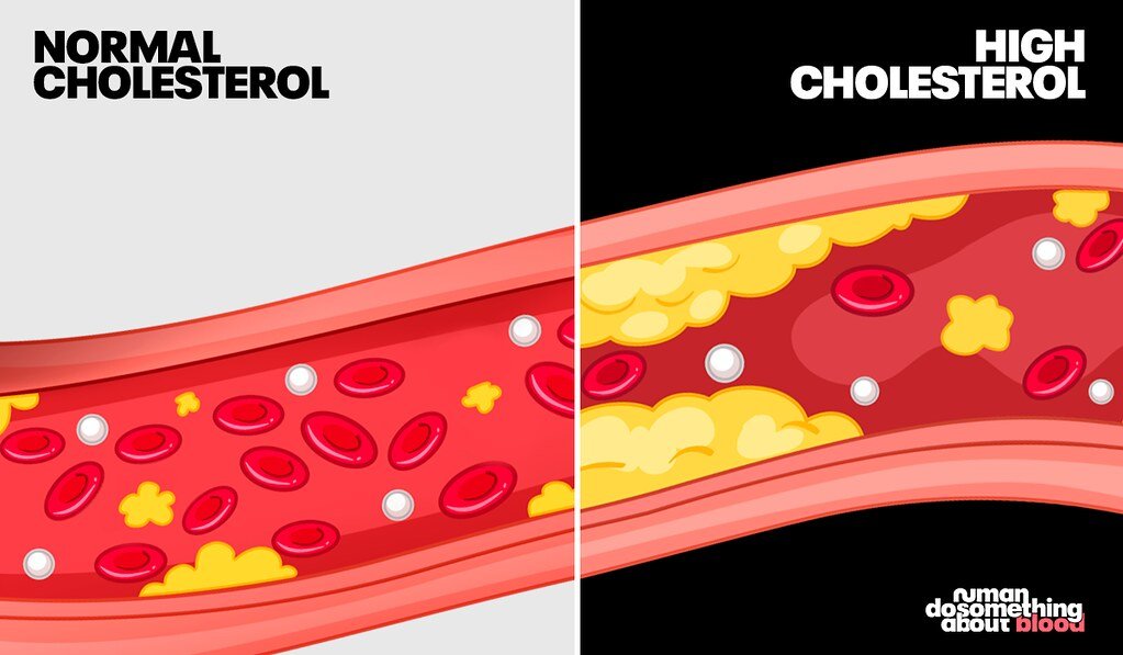 high cholesterol what causes high cholesterol signs of high cholesterol symptoms of high cholesterol in females foods to avoid with high cholesterol what does high cholesterol mean what are 10 warning signs of high cholesterol 15 foods to avoid with high cholesterol what is considered high cholesterol what foods cause high cholesterol what causes high cholesterol in women high cholesterol and high blood pressure high cholesterol and triglycerides high cholesterol and heart disease myth or truth high cholesterol and low blood pressure high cholesterol abbreviation high cholesterol and low vitamin d high cholesterol and ldl high cholesterol and ldl but normal triglycerides high cholesterol and high liver enzymes high cholesterol and alcohol are eggs bad for high cholesterol are eggs high cholesterol avocado high cholesterol are prawns high cholesterol a high cholesterol level is associated with which condition avoid food for high cholesterol a diet for high cholesterol are shrimp high cholesterol are nuts high cholesterol avoid high cholesterol high cholesterol but zero calcium score high cholesterol but low blood pressure high cholesterol but normal blood pressure high cholesterol blood test high cholesterol but zero calcium score reddit high cholesterol but i eat healthy high cholesterol but good blood pressure high cholesterol but low triglycerides high cholesterol but low triglycerides and high hdl high cholesterol but normal triglycerides best diet for high cholesterol best foods for high cholesterol borderline high cholesterol best butter for high cholesterol best cheese for diabetics and high cholesterol best medicine for high cholesterol best greek yogurt for high cholesterol best milk for high cholesterol best ayurvedic medicine for high cholesterol breakfast for high cholesterol high cholesterol causes high cholesterol cause high blood pressure high cholesterol can lead to what high cholesterol can cause high blood pressure high cholesterol cause headaches high cholesterol can cause heart attack high cholesterol can cause what high cholesterol chart high cholesterol called high cholesterol can i eat eggs causes of high cholesterol can stress cause high cholesterol can high cholesterol cause high blood pressure can high cholesterol cause fatigue can high cholesterol cause headaches can high cholesterol cause dizziness can high cholesterol be reversed can alcohol cause high cholesterol causes of high cholesterol in healthy person cheese for high cholesterol high cholesterol diet high cholesterol does not cause heart disease new research finds high cholesterol despite good diet and exercise reddit high cholesterol drinks to avoid high cholesterol during pregnancy high cholesterol diagnosis high cholesterol diet changes high cholesterol drugs high cholesterol diet recipes high cholesterol deposits around the eyes diet for high cholesterol does high cholesterol cause high blood pressure do eggs cause high cholesterol does high cholesterol make you tired does stress cause high cholesterol does high cholesterol cause headaches does alcohol cause high cholesterol does high cholesterol cause weight gain does smoking cause high cholesterol does high cholesterol cause dizziness high cholesterol eyes high cholesterol effects high cholesterol even though i eat healthy high cholesterol effects on body high cholesterol eyelids high cholesterol eye ring high cholesterol eggs high cholesterol exercise high cholesterol eye symptoms high cholesterol erectile dysfunction effects of high cholesterol eggs high cholesterol eye warning signs high cholesterol exercise for high cholesterol effect of high cholesterol in the body early detection high cholesterol eggs cause high cholesterol eyes signs of high cholesterol on face early signs of high cholesterol egg is good for high cholesterol high cholesterol foods high cholesterol foods to avoid high cholesterol foods to avoid chart high cholesterol foods to stay away from high cholesterol foods to avoid list high cholesterol foods to eat high cholesterol foods to eat and avoid high cholesterol foods list high cholesterol foods to avoid pdf high cholesterol fix foods with high cholesterol foods that cause high cholesterol foods good for high cholesterol foods to eat with high cholesterol foods that have high cholesterol for high cholesterol foods that give you high cholesterol fix high cholesterol for high cholesterol diet high cholesterol genetic high cholesterol genetic condition high cholesterol gene high cholesterol genetic testing high cholesterol good for you high cholesterol good foods to eat high cholesterol good high cholesterol guidelines high cholesterol guidelines 2026 high cholesterol grocery list genetic high cholesterol good foods for high cholesterol good diet for high cholesterol genetic high cholesterol symptoms good snacks for high cholesterol genetic condition of very high cholesterol glp 1 for high cholesterol good for high cholesterol green tea good for high cholesterol greek yogurt high cholesterol high cholesterol how to lower high cholesterol hereditary high cholesterol high triglycerides high ldl high cholesterol how to lower it naturally high cholesterol how do you get it high cholesterol high blood pressure high cholesterol headache high cholesterol how to get rid of it high cholesterol high triglycerides high cholesterol hdl how to reduce high cholesterol how to control high cholesterol how do you get high cholesterol high cholesterol symptoms high cholesterol medication high cholesterol medical term high cholesterol icd 10 high cholesterol in kids high cholesterol in women high cholesterol in dogs high cholesterol in 11 year old girl high cholesterol icd 10 code high cholesterol in children high cholesterol in 11 year old boy high cholesterol in 10 year old high cholesterol in pregnancy is high cholesterol bad is high cholesterol genetic icd 10 high cholesterol is high cholesterol is shrimp high cholesterol is cheese high cholesterol is peanut butter high cholesterol is salmon high cholesterol is chicken high cholesterol in high cholesterol what foods to avoid high cholesterol joint pain high cholesterol jokes high cholesterol juice high cholesterol jaw pain high cholesterol juice recipes high cholesterol jab high cholesterol juice cleanse high cholesterol japanese high cholesterol jaundice high cholesterol junk food juice for high cholesterol juice good for high cholesterol juicing recipes for high cholesterol jasmine rice high cholesterol joint pain high cholesterol junk food for high cholesterol juice to reduce high cholesterol just found out i have high cholesterol jam for high cholesterol high cholesterol kids high cholesterol keto diet high cholesterol kidney disease high cholesterol kidney high cholesterol kids diet high cholesterol keto high cholesterol kidney stones high cholesterol keto reddit high cholesterol kaiser high cholesterol kidney function keto and high cholesterol keto diet for high cholesterol kids with high cholesterol keto high cholesterol reddit kidney disease and high cholesterol keto diet good for high cholesterol kamote is good for high cholesterol kiwi good for high cholesterol kimchi for high cholesterol kimchi good for high cholesterol high cholesterol levels high cholesterol low vitamin d and hypothyroidism high cholesterol low triglycerides high cholesterol ldl high cholesterol low blood pressure high cholesterol levels for women high cholesterol ldl and non hdl high cholesterol leads to high cholesterol labs high cholesterol levels for men list of high cholesterol foods lower high cholesterol ldl high cholesterol late night snacks for high cholesterol low vitamin d and high cholesterol low blood pressure high cholesterol low estrogen and high cholesterol low triglycerides high cholesterol low fat diet for high cholesterol low triglycerides but high cholesterol high cholesterol meaning high cholesterol meds high cholesterol medication names high cholesterol medication over the counter high cholesterol meaning in blood test high cholesterol medication side effects high cholesterol medication that is not a statin high cholesterol medical abbreviation managing high cholesterol guidelines medicine for high cholesterol medical term for high cholesterol meds for high cholesterol medications for high cholesterol meals for high cholesterol meal plan for high cholesterol milk for high cholesterol mediterranean diet for high cholesterol menopause and high cholesterol high cholesterol numbers high cholesterol name high cholesterol normal triglycerides high cholesterol natural treatment high cholesterol numbers women high cholesterol normal blood pressure high cholesterol numbers for men high cholesterol natural supplements high cholesterol not bad for you high cholesterol not caused by diet nhs high cholesterol natural supplements for high cholesterol name for high cholesterol nuts for high cholesterol normal triglycerides but high cholesterol niacin for high cholesterol normal blood pressure but high cholesterol nuts good for high cholesterol names of high cholesterol medication normal blood pressure high cholesterol high cholesterol over the counter medication high cholesterol on blood test high cholesterol other name high cholesterol or triglycerides high cholesterol on a vegan diet high cholesterol on keto diet high cholesterol on carnivore diet high cholesterol on low carb diet high cholesterol on accutane high cholesterol on vegetarian diet omega 3 for high cholesterol ozempic for high cholesterol oil for high cholesterol oatmeal for high cholesterol olive oil for high cholesterol oats for high cholesterol overnight oats for high cholesterol olive oil good for high cholesterol oatmeal good for high cholesterol oat milk high cholesterol high cholesterol pills high cholesterol postpartum high cholesterol pregnancy high cholesterol perimenopause high cholesterol pcos high cholesterol problems high cholesterol pills names high cholesterol prevention high cholesterol patient education pdf spanish high cholesterol patient handout pdf pediatric high cholesterol treatment pcos and high cholesterol printable list of foods to avoid with high cholesterol pills for high cholesterol physical signs of high cholesterol peanut butter high cholesterol prawn high cholesterol peanut butter good for high cholesterol pasta for high cholesterol prevent high cholesterol high cholesterol qualify for glp 1 high cholesterol quick fix high cholesterol quiz high cholesterol qrisk high cholesterol qualify for ozempic high cholesterol quora high cholesterol quetiapine high cholesterol quotes high cholesterol qualify for wegovy questions about high cholesterol quinoa good for high cholesterol quail egg is high cholesterol quinoa for high cholesterol quaker oats good for high cholesterol quick fix for high cholesterol quetiapine high cholesterol quick meals for high cholesterol quinoa recipes for high cholesterol quick remedy for high cholesterol quaker oats for high cholesterol high cholesterol risks high cholesterol range high cholesterol reddit high cholesterol recipes high cholesterol reasons high cholesterol remedies high cholesterol risk factors high cholesterol runs in my family high cholesterol reversible high cholesterol reading reasons for high cholesterol recipes for high cholesterol risks of high cholesterol remedy for high cholesterol reduce high cholesterol reasons for high cholesterol in women red yeast rice for high cholesterol recipes for people with high cholesterol reverse high cholesterol rosuvastatin dosage for high cholesterol high cholesterol symptoms in women high cholesterol supplements high cholesterol side effects high cholesterol symptoms in men high cholesterol signs high cholesterol signs in legs and feet high cholesterol shot high cholesterol symptoms feet high cholesterol statin symptoms of high cholesterol signs of high cholesterol on face side effects of high cholesterol symptoms of high cholesterol in males supplements for high cholesterol statins for high cholesterol is high cholesterol the same as high blood pressure signs and symptoms of high cholesterol high cholesterol treatments high cholesterol term high cholesterol test high cholesterol triglycerides and ldl high cholesterol total high cholesterol triglycerides high cholesterol triglycerides ldl and non hdl high cholesterol treatment at home high cholesterol tea high cholesterol terminology top ten worst foods for high cholesterol treatment for high cholesterol treat high cholesterol the symptoms of high cholesterol the effects of high cholesterol the best diet for high cholesterol the cause of high cholesterol to reduce high cholesterol the best food for high cholesterol triglycerides high cholesterol high cholesterol unspecified icd 10 high cholesterol urine smell high cholesterol under eyes high cholesterol untreated high cholesterol underweight high cholesterol urine high cholesterol ulcerative colitis high cholesterol under 30 high cholesterol urine color high cholesterol underlying causes untreated high cholesterol underactive thyroid and high cholesterol understanding high cholesterol underweight but high cholesterol underweight with high cholesterol use of statins for high cholesterol uni high cholesterol unexplained high cholesterol uric acid and high cholesterol unani medicine for high cholesterol high cholesterol vitamins high cholesterol vegan foods to avoid high cholesterol va rating high cholesterol vs hyperlipidemia high cholesterol vegetarian high cholesterol va rating secondary high cholesterol values high cholesterol vs low cholesterol foods high cholesterol vs triglycerides vitamins for high cholesterol very high cholesterol vegetables for high cholesterol very high cholesterol symptoms vegetarian with high cholesterol very high cholesterol level vegan with high cholesterol vitamin d deficiency and high cholesterol vegetables good for high cholesterol vitamin d and high cholesterol high cholesterol what does it mean high cholesterol what not to eat high cholesterol with low blood pressure high cholesterol what foods to avoid high cholesterol with normal blood pressure high cholesterol while pregnant high cholesterol with zero calcium score high cholesterol what to do high cholesterol while breastfeeding high cholesterol with healthy diet and exercise what is high cholesterol what foods to avoid with high cholesterol what are the symptoms of high cholesterol why is high cholesterol bad high cholesterol xanthomas high cholesterol xanthelasma high cholesterol xerostomia high cholesterol x ray high cholesterol symptoms xanthomas high cholesterol mild xanthelasma high cholesterol chest x ray cholesterol and xanthelasma xanthelasma high cholesterol symptoms eyes xeljanz high cholesterol xanthelasma without high cholesterol xanthelasma high cholesterol xanthomas high cholesterol xanthelasma but not high cholesterol xanthelasma signs of high cholesterol on face xanthelasma means high cholesterol xanthelasma high cholesterol eyes xanax and high cholesterol high cholesterol young woman high cholesterol yogurt high cholesterol young high cholesterol young age high cholesterol yellow eyelids high cholesterol young male high cholesterol yellow nodules high cholesterol yellow eyes high cholesterol yoga high cholesterol young person yogurt for high cholesterol yoga for high cholesterol yogurt good for high cholesterol yoga for high cholesterol and triglycerides yakult good for high cholesterol young celebrities with high cholesterol you have high cholesterol yakult for high cholesterol young with high cholesterol young people with high cholesterol high cholesterol zero calcium score high cholesterol zepbound high cholesterol zetia high cholesterol zoloft high cholesterol zhongwen high cholesterol and zero calcium high cholesterol zyn high cholesterol zero to finals high cholesterol zoe high cholesterol zinc zepbound for high cholesterol zetia for high cholesterol zero calcium score but high cholesterol zoloft and high cholesterol zoloft cause high cholesterol zero calcium score with high cholesterol zepbound cause high cholesterol zyn and high cholesterol zepbound help with high cholesterol zucchini good for high cholesterol high cholesterol 0 calcium score high cholesterol e78 00 high cholesterol but 0 cac score high cholesterol icd 0 high cholesterol icd 09 cholesterol of 0 0 calcium score and high cholesterol 0 calcium score but high cholesterol cholesterol total 01 high high density lipoprotein hdl cholesterol 0.9 is 0.7 cholesterol high is 0 greek yogurt high in cholesterol high cholesterol 19 year old female high cholesterol 11 year old girl high cholesterol 10 year old girl high cholesterol 19 year old male high cholesterol 18 year old male high cholesterol 12 year old boy high cholesterol 1 year postpartum high cholesterol 10 year old high cholesterol 12 year old high cholesterol 11 year old 10 year old high cholesterol 11 year old high cholesterol 15 foods to avoid with high cholesterol vegetarian 18 year old with high cholesterol 10 warning signs of high cholesterol 12 year old boy high cholesterol 11 year old girl high cholesterol 19 year old female high cholesterol 12 year old girl with high cholesterol high cholesterol 26 year old female high cholesterol 27 year old female high cholesterol 20 year old female high cholesterol 29 year old female high cholesterol 20 year old male high cholesterol 28 year old male high cholesterol 25 year old male high cholesterol 200 high cholesterol 250 high cholesterol 28 year old woman 250 high cholesterol 240 high cholesterol 220 high cholesterol 200 high cholesterol 230 high cholesterol 27 with high cholesterol 26 with high cholesterol 23 with high cholesterol 210 high cholesterol 25 with high cholesterol high cholesterol 30 year old male high cholesterol 35 year old female high cholesterol 31 year old male high cholesterol 3 months postpartum high cholesterol 300 high cholesterol 32 year old male high cholesterol 36 years old high cholesterol 30s high cholesterol 30 year old female high cholesterol 31 year old female 30 year old with high cholesterol 35 with high cholesterol 33 years old high cholesterol 32 with high cholesterol 34 years old high cholesterol 30 with high cholesterol 30 year old female high cholesterol 30 year old male high cholesterol 300 high cholesterol level 37 with high cholesterol high cholesterol 40 year old man high cholesterol 4 months postpartum high cholesterol 400 high cholesterol 40 year old woman high cholesterol 41 year old woman high cholesterol 44 year old woman high cholesterol 43 year old woman high cholesterol 4.5 high cholesterol 4.1 high cholesterol 45 year old woman 40 foods to high cholesterol 40 year old woman high cholesterol 40 year old high cholesterol 4 year old high cholesterol 40 year old male with high cholesterol 40 with high cholesterol 4 eggs a day high cholesterol 43 year old female high cholesterol 400 high cholesterol 46 year old woman high cholesterol high cholesterol 5 months postpartum high cholesterol 500 high cholesterol 5 year old high cholesterol 55 year old woman high cholesterol 5.7 high cholesterol 5.5 high cholesterol 5.9 high cholesterol 5.6 high cholesterol 5.2 5 signs of high cholesterol 5 foods to avoid with high cholesterol 5 worst foods for high cholesterol 5 year old high cholesterol 5 symptoms of high cholesterol 5.6 high cholesterol 5 subtle signs of high cholesterol 5.5 high cholesterol 5.7 high cholesterol 5.9 high cholesterol high cholesterol 600 high cholesterol 6 months postpartum high cholesterol 6 months postpartum reddit high cholesterol 6 weeks postpartum high cholesterol 6.1 high cholesterol 6.5 high cholesterol 6.7 high cholesterol 6.4 high cholesterol 6.2 6 worst foods for high cholesterol 6 month injection for high cholesterol 6.5 high cholesterol reading 6 year old with high cholesterol 6.9 high cholesterol reading 6.4 high cholesterol 6.6 high cholesterol 6.1 high cholesterol reading 6.8 high cholesterol reading 6.2 high cholesterol reading high cholesterol 7 months postpartum high cholesterol 7 year old high cholesterol 7.5 high cholesterol 7.2 high cholesterol 7.4 high cholesterol 7.1 high cholesterol 7.3 high cholesterol 7.8 high cholesterol 7.9 7 day meal plan for high cholesterol 7.5 high cholesterol reading 7 year old with high cholesterol 7.2 high cholesterol 7.1 high cholesterol 7.7 high cholesterol 7.8 high cholesterol level 7.4 high cholesterol 7.5 high cholesterol 7 signs of high cholesterol high cholesterol 8 months postpartum high cholesterol 8 year old high cholesterol 8 weeks postpartum high cholesterol 8.1 high cholesterol 8.5 high cholesterol 8.9 high cholesterol 8.4 high cholesterol 8.6 high cholesterol 8.2 8 year old high cholesterol 8 crucial signs of high cholesterol 8 signs of high cholesterol 8 foods that help high cholesterol 80 year old with high cholesterol 8 high cholesterol mistakes to avoid is 8 a high cholesterol level is 8.5 high cholesterol is 8.3 high cholesterol high cholesterol 9 year old high cholesterol 9 months postpartum high cholesterol 9.5 high cholesterol 900 high cholesterol 9.1 high cholesterol 9.2 high cholesterol 9.3 high cholesterol icd 9 high cholesterol icd 9 code 9 year old high cholesterol 9 year old boy with high cholesterol 9 worst foods for high cholesterol 9 pain symptoms of high cholesterol 9 year old with high cholesterol and triglycerides icd 9 code for high cholesterol is 9 a high cholesterol level icd 9 code for high cholesterol unspecified is 9.5 high cholesterol