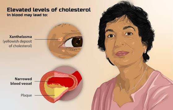 high cholesterol what causes high cholesterol signs of high cholesterol symptoms of high cholesterol in females foods to avoid with high cholesterol what does high cholesterol mean what are 10 warning signs of high cholesterol 15 foods to avoid with high cholesterol what is considered high cholesterol what foods cause high cholesterol what causes high cholesterol in women high cholesterol and high blood pressure high cholesterol and triglycerides high cholesterol and heart disease myth or truth high cholesterol and low blood pressure high cholesterol abbreviation high cholesterol and low vitamin d high cholesterol and ldl high cholesterol and ldl but normal triglycerides high cholesterol and high liver enzymes high cholesterol and alcohol are eggs bad for high cholesterol are eggs high cholesterol avocado high cholesterol are prawns high cholesterol a high cholesterol level is associated with which condition avoid food for high cholesterol a diet for high cholesterol are shrimp high cholesterol are nuts high cholesterol avoid high cholesterol high cholesterol but zero calcium score high cholesterol but low blood pressure high cholesterol but normal blood pressure high cholesterol blood test high cholesterol but zero calcium score reddit high cholesterol but i eat healthy high cholesterol but good blood pressure high cholesterol but low triglycerides high cholesterol but low triglycerides and high hdl high cholesterol but normal triglycerides best diet for high cholesterol best foods for high cholesterol borderline high cholesterol best butter for high cholesterol best cheese for diabetics and high cholesterol best medicine for high cholesterol best greek yogurt for high cholesterol best milk for high cholesterol best ayurvedic medicine for high cholesterol breakfast for high cholesterol high cholesterol causes high cholesterol cause high blood pressure high cholesterol can lead to what high cholesterol can cause high blood pressure high cholesterol cause headaches high cholesterol can cause heart attack high cholesterol can cause what high cholesterol chart high cholesterol called high cholesterol can i eat eggs causes of high cholesterol can stress cause high cholesterol can high cholesterol cause high blood pressure can high cholesterol cause fatigue can high cholesterol cause headaches can high cholesterol cause dizziness can high cholesterol be reversed can alcohol cause high cholesterol causes of high cholesterol in healthy person cheese for high cholesterol high cholesterol diet high cholesterol does not cause heart disease new research finds high cholesterol despite good diet and exercise reddit high cholesterol drinks to avoid high cholesterol during pregnancy high cholesterol diagnosis high cholesterol diet changes high cholesterol drugs high cholesterol diet recipes high cholesterol deposits around the eyes diet for high cholesterol does high cholesterol cause high blood pressure do eggs cause high cholesterol does high cholesterol make you tired does stress cause high cholesterol does high cholesterol cause headaches does alcohol cause high cholesterol does high cholesterol cause weight gain does smoking cause high cholesterol does high cholesterol cause dizziness high cholesterol eyes high cholesterol effects high cholesterol even though i eat healthy high cholesterol effects on body high cholesterol eyelids high cholesterol eye ring high cholesterol eggs high cholesterol exercise high cholesterol eye symptoms high cholesterol erectile dysfunction effects of high cholesterol eggs high cholesterol eye warning signs high cholesterol exercise for high cholesterol effect of high cholesterol in the body early detection high cholesterol eggs cause high cholesterol eyes signs of high cholesterol on face early signs of high cholesterol egg is good for high cholesterol high cholesterol foods high cholesterol foods to avoid high cholesterol foods to avoid chart high cholesterol foods to stay away from high cholesterol foods to avoid list high cholesterol foods to eat high cholesterol foods to eat and avoid high cholesterol foods list high cholesterol foods to avoid pdf high cholesterol fix foods with high cholesterol foods that cause high cholesterol foods good for high cholesterol foods to eat with high cholesterol foods that have high cholesterol for high cholesterol foods that give you high cholesterol fix high cholesterol for high cholesterol diet high cholesterol genetic high cholesterol genetic condition high cholesterol gene high cholesterol genetic testing high cholesterol good for you high cholesterol good foods to eat high cholesterol good high cholesterol guidelines high cholesterol guidelines 2026 high cholesterol grocery list genetic high cholesterol good foods for high cholesterol good diet for high cholesterol genetic high cholesterol symptoms good snacks for high cholesterol genetic condition of very high cholesterol glp 1 for high cholesterol good for high cholesterol green tea good for high cholesterol greek yogurt high cholesterol high cholesterol how to lower high cholesterol hereditary high cholesterol high triglycerides high ldl high cholesterol how to lower it naturally high cholesterol how do you get it high cholesterol high blood pressure high cholesterol headache high cholesterol how to get rid of it high cholesterol high triglycerides high cholesterol hdl how to reduce high cholesterol how to control high cholesterol how do you get high cholesterol high cholesterol symptoms high cholesterol medication high cholesterol medical term high cholesterol icd 10 high cholesterol in kids high cholesterol in women high cholesterol in dogs high cholesterol in 11 year old girl high cholesterol icd 10 code high cholesterol in children high cholesterol in 11 year old boy high cholesterol in 10 year old high cholesterol in pregnancy is high cholesterol bad is high cholesterol genetic icd 10 high cholesterol is high cholesterol is shrimp high cholesterol is cheese high cholesterol is peanut butter high cholesterol is salmon high cholesterol is chicken high cholesterol in high cholesterol what foods to avoid high cholesterol joint pain high cholesterol jokes high cholesterol juice high cholesterol jaw pain high cholesterol juice recipes high cholesterol jab high cholesterol juice cleanse high cholesterol japanese high cholesterol jaundice high cholesterol junk food juice for high cholesterol juice good for high cholesterol juicing recipes for high cholesterol jasmine rice high cholesterol joint pain high cholesterol junk food for high cholesterol juice to reduce high cholesterol just found out i have high cholesterol jam for high cholesterol high cholesterol kids high cholesterol keto diet high cholesterol kidney disease high cholesterol kidney high cholesterol kids diet high cholesterol keto high cholesterol kidney stones high cholesterol keto reddit high cholesterol kaiser high cholesterol kidney function keto and high cholesterol keto diet for high cholesterol kids with high cholesterol keto high cholesterol reddit kidney disease and high cholesterol keto diet good for high cholesterol kamote is good for high cholesterol kiwi good for high cholesterol kimchi for high cholesterol kimchi good for high cholesterol high cholesterol levels high cholesterol low vitamin d and hypothyroidism high cholesterol low triglycerides high cholesterol ldl high cholesterol low blood pressure high cholesterol levels for women high cholesterol ldl and non hdl high cholesterol leads to high cholesterol labs high cholesterol levels for men list of high cholesterol foods lower high cholesterol ldl high cholesterol late night snacks for high cholesterol low vitamin d and high cholesterol low blood pressure high cholesterol low estrogen and high cholesterol low triglycerides high cholesterol low fat diet for high cholesterol low triglycerides but high cholesterol high cholesterol meaning high cholesterol meds high cholesterol medication names high cholesterol medication over the counter high cholesterol meaning in blood test high cholesterol medication side effects high cholesterol medication that is not a statin high cholesterol medical abbreviation managing high cholesterol guidelines medicine for high cholesterol medical term for high cholesterol meds for high cholesterol medications for high cholesterol meals for high cholesterol meal plan for high cholesterol milk for high cholesterol mediterranean diet for high cholesterol menopause and high cholesterol high cholesterol numbers high cholesterol name high cholesterol normal triglycerides high cholesterol natural treatment high cholesterol numbers women high cholesterol normal blood pressure high cholesterol numbers for men high cholesterol natural supplements high cholesterol not bad for you high cholesterol not caused by diet nhs high cholesterol natural supplements for high cholesterol name for high cholesterol nuts for high cholesterol normal triglycerides but high cholesterol niacin for high cholesterol normal blood pressure but high cholesterol nuts good for high cholesterol names of high cholesterol medication normal blood pressure high cholesterol high cholesterol over the counter medication high cholesterol on blood test high cholesterol other name high cholesterol or triglycerides high cholesterol on a vegan diet high cholesterol on keto diet high cholesterol on carnivore diet high cholesterol on low carb diet high cholesterol on accutane high cholesterol on vegetarian diet omega 3 for high cholesterol ozempic for high cholesterol oil for high cholesterol oatmeal for high cholesterol olive oil for high cholesterol oats for high cholesterol overnight oats for high cholesterol olive oil good for high cholesterol oatmeal good for high cholesterol oat milk high cholesterol high cholesterol pills high cholesterol postpartum high cholesterol pregnancy high cholesterol perimenopause high cholesterol pcos high cholesterol problems high cholesterol pills names high cholesterol prevention high cholesterol patient education pdf spanish high cholesterol patient handout pdf pediatric high cholesterol treatment pcos and high cholesterol printable list of foods to avoid with high cholesterol pills for high cholesterol physical signs of high cholesterol peanut butter high cholesterol prawn high cholesterol peanut butter good for high cholesterol pasta for high cholesterol prevent high cholesterol high cholesterol qualify for glp 1 high cholesterol quick fix high cholesterol quiz high cholesterol qrisk high cholesterol qualify for ozempic high cholesterol quora high cholesterol quetiapine high cholesterol quotes high cholesterol qualify for wegovy questions about high cholesterol quinoa good for high cholesterol quail egg is high cholesterol quinoa for high cholesterol quaker oats good for high cholesterol quick fix for high cholesterol quetiapine high cholesterol quick meals for high cholesterol quinoa recipes for high cholesterol quick remedy for high cholesterol quaker oats for high cholesterol high cholesterol risks high cholesterol range high cholesterol reddit high cholesterol recipes high cholesterol reasons high cholesterol remedies high cholesterol risk factors high cholesterol runs in my family high cholesterol reversible high cholesterol reading reasons for high cholesterol recipes for high cholesterol risks of high cholesterol remedy for high cholesterol reduce high cholesterol reasons for high cholesterol in women red yeast rice for high cholesterol recipes for people with high cholesterol reverse high cholesterol rosuvastatin dosage for high cholesterol high cholesterol symptoms in women high cholesterol supplements high cholesterol side effects high cholesterol symptoms in men high cholesterol signs high cholesterol signs in legs and feet high cholesterol shot high cholesterol symptoms feet high cholesterol statin symptoms of high cholesterol signs of high cholesterol on face side effects of high cholesterol symptoms of high cholesterol in males supplements for high cholesterol statins for high cholesterol is high cholesterol the same as high blood pressure signs and symptoms of high cholesterol high cholesterol treatments high cholesterol term high cholesterol test high cholesterol triglycerides and ldl high cholesterol total high cholesterol triglycerides high cholesterol triglycerides ldl and non hdl high cholesterol treatment at home high cholesterol tea high cholesterol terminology top ten worst foods for high cholesterol treatment for high cholesterol treat high cholesterol the symptoms of high cholesterol the effects of high cholesterol the best diet for high cholesterol the cause of high cholesterol to reduce high cholesterol the best food for high cholesterol triglycerides high cholesterol high cholesterol unspecified icd 10 high cholesterol urine smell high cholesterol under eyes high cholesterol untreated high cholesterol underweight high cholesterol urine high cholesterol ulcerative colitis high cholesterol under 30 high cholesterol urine color high cholesterol underlying causes untreated high cholesterol underactive thyroid and high cholesterol understanding high cholesterol underweight but high cholesterol underweight with high cholesterol use of statins for high cholesterol uni high cholesterol unexplained high cholesterol uric acid and high cholesterol unani medicine for high cholesterol high cholesterol vitamins high cholesterol vegan foods to avoid high cholesterol va rating high cholesterol vs hyperlipidemia high cholesterol vegetarian high cholesterol va rating secondary high cholesterol values high cholesterol vs low cholesterol foods high cholesterol vs triglycerides vitamins for high cholesterol very high cholesterol vegetables for high cholesterol very high cholesterol symptoms vegetarian with high cholesterol very high cholesterol level vegan with high cholesterol vitamin d deficiency and high cholesterol vegetables good for high cholesterol vitamin d and high cholesterol high cholesterol what does it mean high cholesterol what not to eat high cholesterol with low blood pressure high cholesterol what foods to avoid high cholesterol with normal blood pressure high cholesterol while pregnant high cholesterol with zero calcium score high cholesterol what to do high cholesterol while breastfeeding high cholesterol with healthy diet and exercise what is high cholesterol what foods to avoid with high cholesterol what are the symptoms of high cholesterol why is high cholesterol bad high cholesterol xanthomas high cholesterol xanthelasma high cholesterol xerostomia high cholesterol x ray high cholesterol symptoms xanthomas high cholesterol mild xanthelasma high cholesterol chest x ray cholesterol and xanthelasma xanthelasma high cholesterol symptoms eyes xeljanz high cholesterol xanthelasma without high cholesterol xanthelasma high cholesterol xanthomas high cholesterol xanthelasma but not high cholesterol xanthelasma signs of high cholesterol on face xanthelasma means high cholesterol xanthelasma high cholesterol eyes xanax and high cholesterol high cholesterol young woman high cholesterol yogurt high cholesterol young high cholesterol young age high cholesterol yellow eyelids high cholesterol young male high cholesterol yellow nodules high cholesterol yellow eyes high cholesterol yoga high cholesterol young person yogurt for high cholesterol yoga for high cholesterol yogurt good for high cholesterol yoga for high cholesterol and triglycerides yakult good for high cholesterol young celebrities with high cholesterol you have high cholesterol yakult for high cholesterol young with high cholesterol young people with high cholesterol high cholesterol zero calcium score high cholesterol zepbound high cholesterol zetia high cholesterol zoloft high cholesterol zhongwen high cholesterol and zero calcium high cholesterol zyn high cholesterol zero to finals high cholesterol zoe high cholesterol zinc zepbound for high cholesterol zetia for high cholesterol zero calcium score but high cholesterol zoloft and high cholesterol zoloft cause high cholesterol zero calcium score with high cholesterol zepbound cause high cholesterol zyn and high cholesterol zepbound help with high cholesterol zucchini good for high cholesterol high cholesterol 0 calcium score high cholesterol e78 00 high cholesterol but 0 cac score high cholesterol icd 0 high cholesterol icd 09 cholesterol of 0 0 calcium score and high cholesterol 0 calcium score but high cholesterol cholesterol total 01 high high density lipoprotein hdl cholesterol 0.9 is 0.7 cholesterol high is 0 greek yogurt high in cholesterol high cholesterol 19 year old female high cholesterol 11 year old girl high cholesterol 10 year old girl high cholesterol 19 year old male high cholesterol 18 year old male high cholesterol 12 year old boy high cholesterol 1 year postpartum high cholesterol 10 year old high cholesterol 12 year old high cholesterol 11 year old 10 year old high cholesterol 11 year old high cholesterol 15 foods to avoid with high cholesterol vegetarian 18 year old with high cholesterol 10 warning signs of high cholesterol 12 year old boy high cholesterol 11 year old girl high cholesterol 19 year old female high cholesterol 12 year old girl with high cholesterol high cholesterol 26 year old female high cholesterol 27 year old female high cholesterol 20 year old female high cholesterol 29 year old female high cholesterol 20 year old male high cholesterol 28 year old male high cholesterol 25 year old male high cholesterol 200 high cholesterol 250 high cholesterol 28 year old woman 250 high cholesterol 240 high cholesterol 220 high cholesterol 200 high cholesterol 230 high cholesterol 27 with high cholesterol 26 with high cholesterol 23 with high cholesterol 210 high cholesterol 25 with high cholesterol high cholesterol 30 year old male high cholesterol 35 year old female high cholesterol 31 year old male high cholesterol 3 months postpartum high cholesterol 300 high cholesterol 32 year old male high cholesterol 36 years old high cholesterol 30s high cholesterol 30 year old female high cholesterol 31 year old female 30 year old with high cholesterol 35 with high cholesterol 33 years old high cholesterol 32 with high cholesterol 34 years old high cholesterol 30 with high cholesterol 30 year old female high cholesterol 30 year old male high cholesterol 300 high cholesterol level 37 with high cholesterol high cholesterol 40 year old man high cholesterol 4 months postpartum high cholesterol 400 high cholesterol 40 year old woman high cholesterol 41 year old woman high cholesterol 44 year old woman high cholesterol 43 year old woman high cholesterol 4.5 high cholesterol 4.1 high cholesterol 45 year old woman 40 foods to high cholesterol 40 year old woman high cholesterol 40 year old high cholesterol 4 year old high cholesterol 40 year old male with high cholesterol 40 with high cholesterol 4 eggs a day high cholesterol 43 year old female high cholesterol 400 high cholesterol 46 year old woman high cholesterol high cholesterol 5 months postpartum high cholesterol 500 high cholesterol 5 year old high cholesterol 55 year old woman high cholesterol 5.7 high cholesterol 5.5 high cholesterol 5.9 high cholesterol 5.6 high cholesterol 5.2 5 signs of high cholesterol 5 foods to avoid with high cholesterol 5 worst foods for high cholesterol 5 year old high cholesterol 5 symptoms of high cholesterol 5.6 high cholesterol 5 subtle signs of high cholesterol 5.5 high cholesterol 5.7 high cholesterol 5.9 high cholesterol high cholesterol 600 high cholesterol 6 months postpartum high cholesterol 6 months postpartum reddit high cholesterol 6 weeks postpartum high cholesterol 6.1 high cholesterol 6.5 high cholesterol 6.7 high cholesterol 6.4 high cholesterol 6.2 6 worst foods for high cholesterol 6 month injection for high cholesterol 6.5 high cholesterol reading 6 year old with high cholesterol 6.9 high cholesterol reading 6.4 high cholesterol 6.6 high cholesterol 6.1 high cholesterol reading 6.8 high cholesterol reading 6.2 high cholesterol reading high cholesterol 7 months postpartum high cholesterol 7 year old high cholesterol 7.5 high cholesterol 7.2 high cholesterol 7.4 high cholesterol 7.1 high cholesterol 7.3 high cholesterol 7.8 high cholesterol 7.9 7 day meal plan for high cholesterol 7.5 high cholesterol reading 7 year old with high cholesterol 7.2 high cholesterol 7.1 high cholesterol 7.7 high cholesterol 7.8 high cholesterol level 7.4 high cholesterol 7.5 high cholesterol 7 signs of high cholesterol high cholesterol 8 months postpartum high cholesterol 8 year old high cholesterol 8 weeks postpartum high cholesterol 8.1 high cholesterol 8.5 high cholesterol 8.9 high cholesterol 8.4 high cholesterol 8.6 high cholesterol 8.2 8 year old high cholesterol 8 crucial signs of high cholesterol 8 signs of high cholesterol 8 foods that help high cholesterol 80 year old with high cholesterol 8 high cholesterol mistakes to avoid is 8 a high cholesterol level is 8.5 high cholesterol is 8.3 high cholesterol high cholesterol 9 year old high cholesterol 9 months postpartum high cholesterol 9.5 high cholesterol 900 high cholesterol 9.1 high cholesterol 9.2 high cholesterol 9.3 high cholesterol icd 9 high cholesterol icd 9 code 9 year old high cholesterol 9 year old boy with high cholesterol 9 worst foods for high cholesterol 9 pain symptoms of high cholesterol 9 year old with high cholesterol and triglycerides icd 9 code for high cholesterol is 9 a high cholesterol level icd 9 code for high cholesterol unspecified is 9.5 high cholesterol